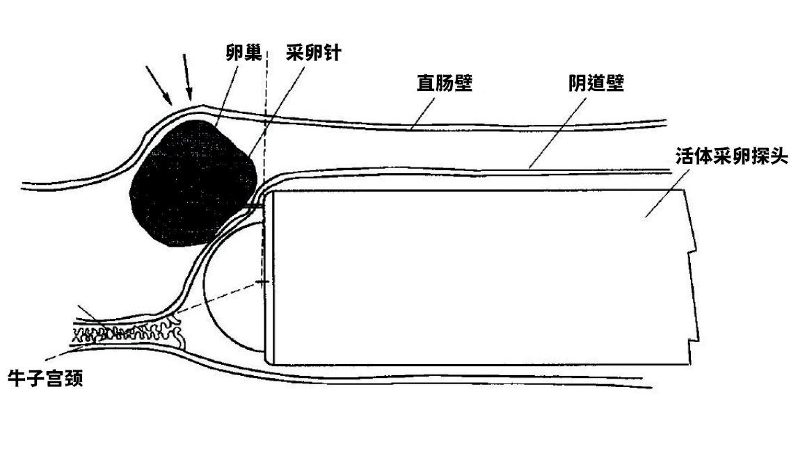 牛活体采卵过程示意图